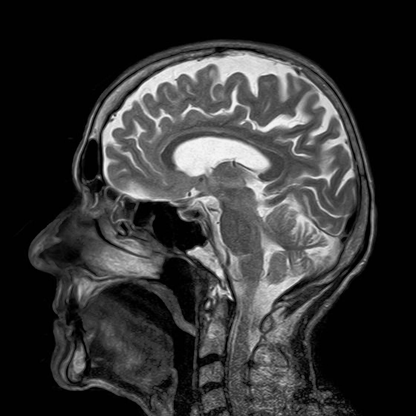 MRI, skan mózgu, przewidywanie demencji, demencja MRI, rezonans magnetyczny