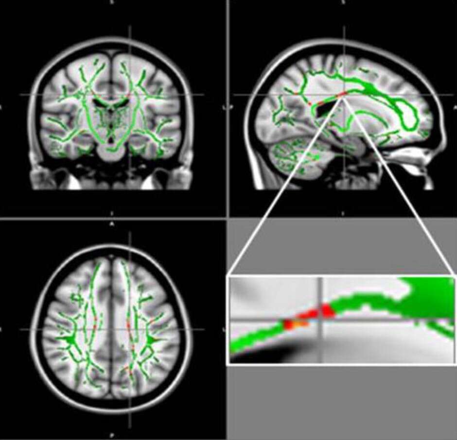 badanie mózgu, mózg a otyłość, uszkodzenia mózgu otyłością, skutki otyłości