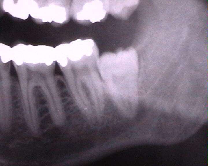 Po co nam zęby mądrości?