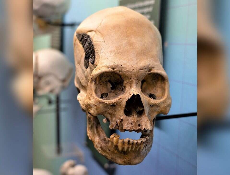 Podłużna czaszka z wszczepionym implantem. Naukowcy próbują zrozumieć, skąd wzięła się na terenie Peru